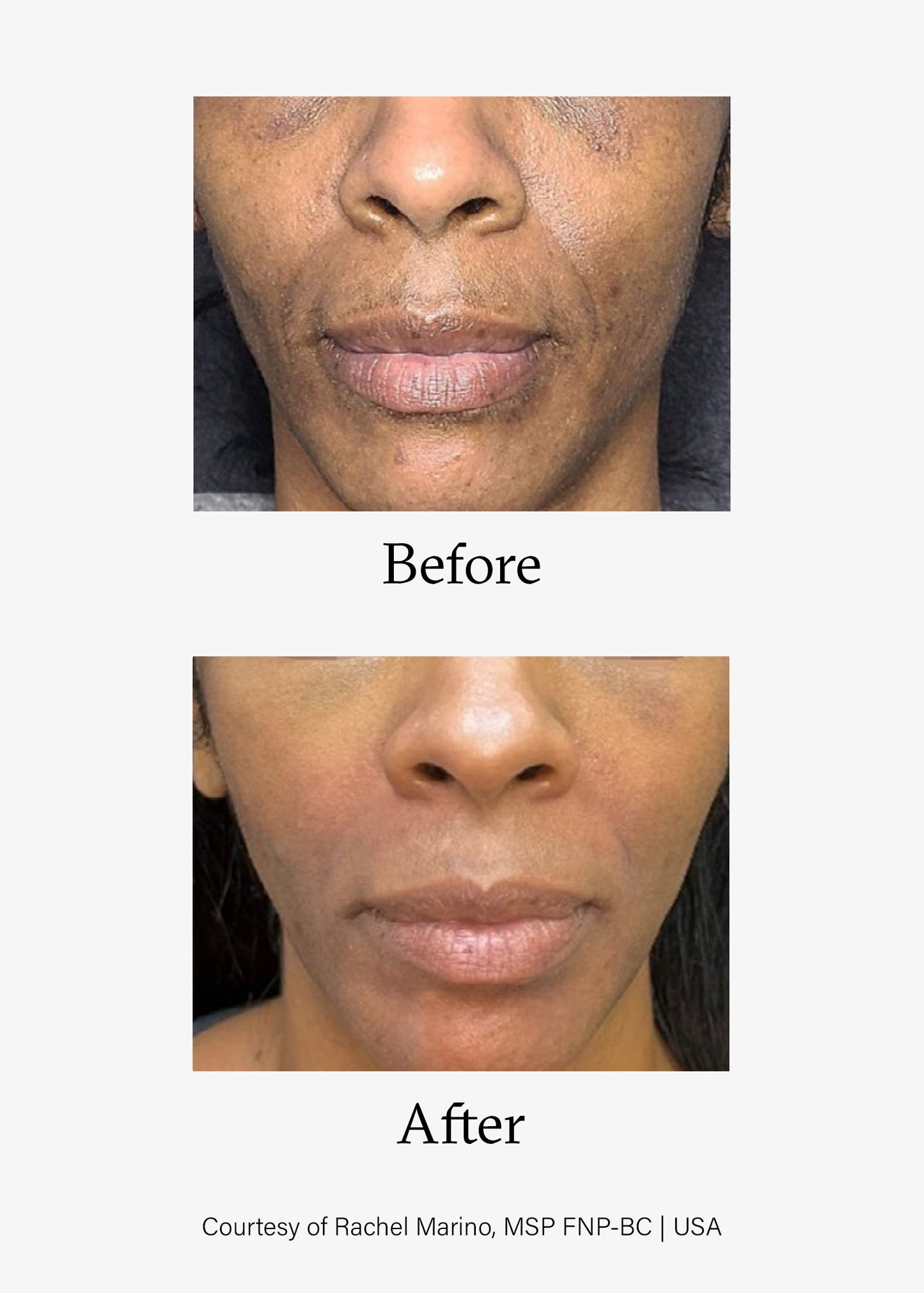 Before and after image of Advanced Skin Resurfacing treatment. Opus Plasma® Powered by Alma® Targeted treatments at Teresa Tarmey skin care Clinic