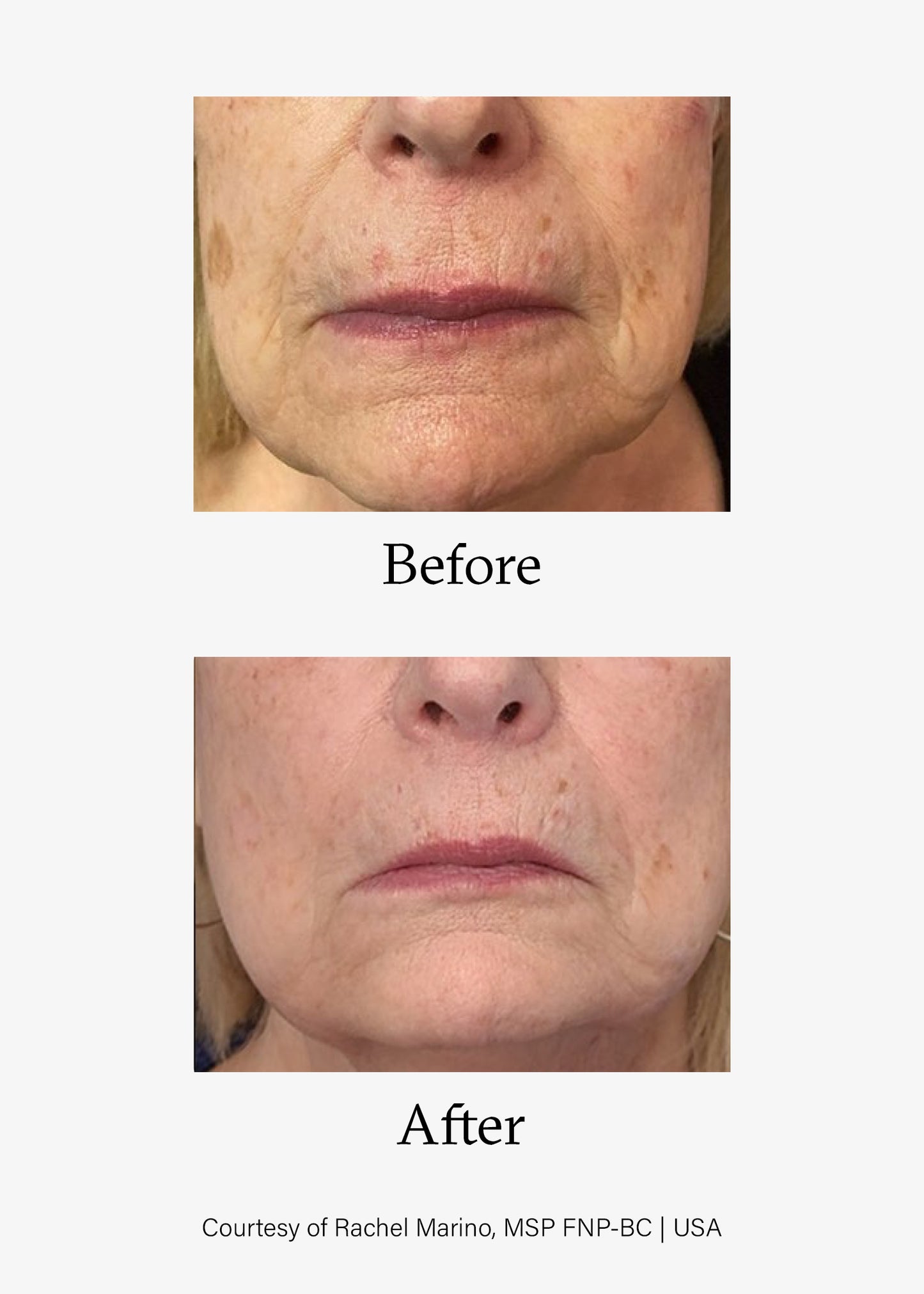 Before and after image of Advanced Skin Resurfacing treatment. Opus Plasma® Powered by Alma® Targeted treatments at Teresa Tarmey skin care Clinic