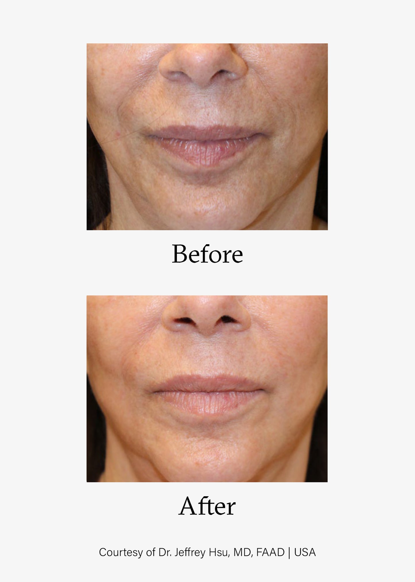 Before and after image of Advanced Skin Resurfacing treatment. Opus Plasma® Powered by Alma® Targeted treatments at Teresa Tarmey skin care Clinic