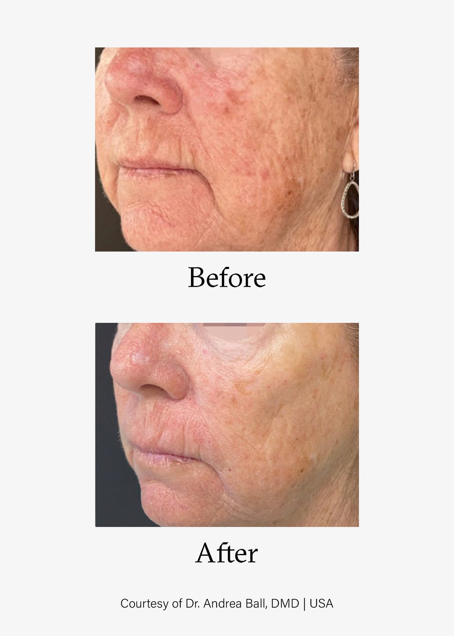 Before and after image of Advanced Skin Resurfacing treatment. Opus Plasma® Powered by Alma® Targeted treatments at Teresa Tarmey skin care Clinic
