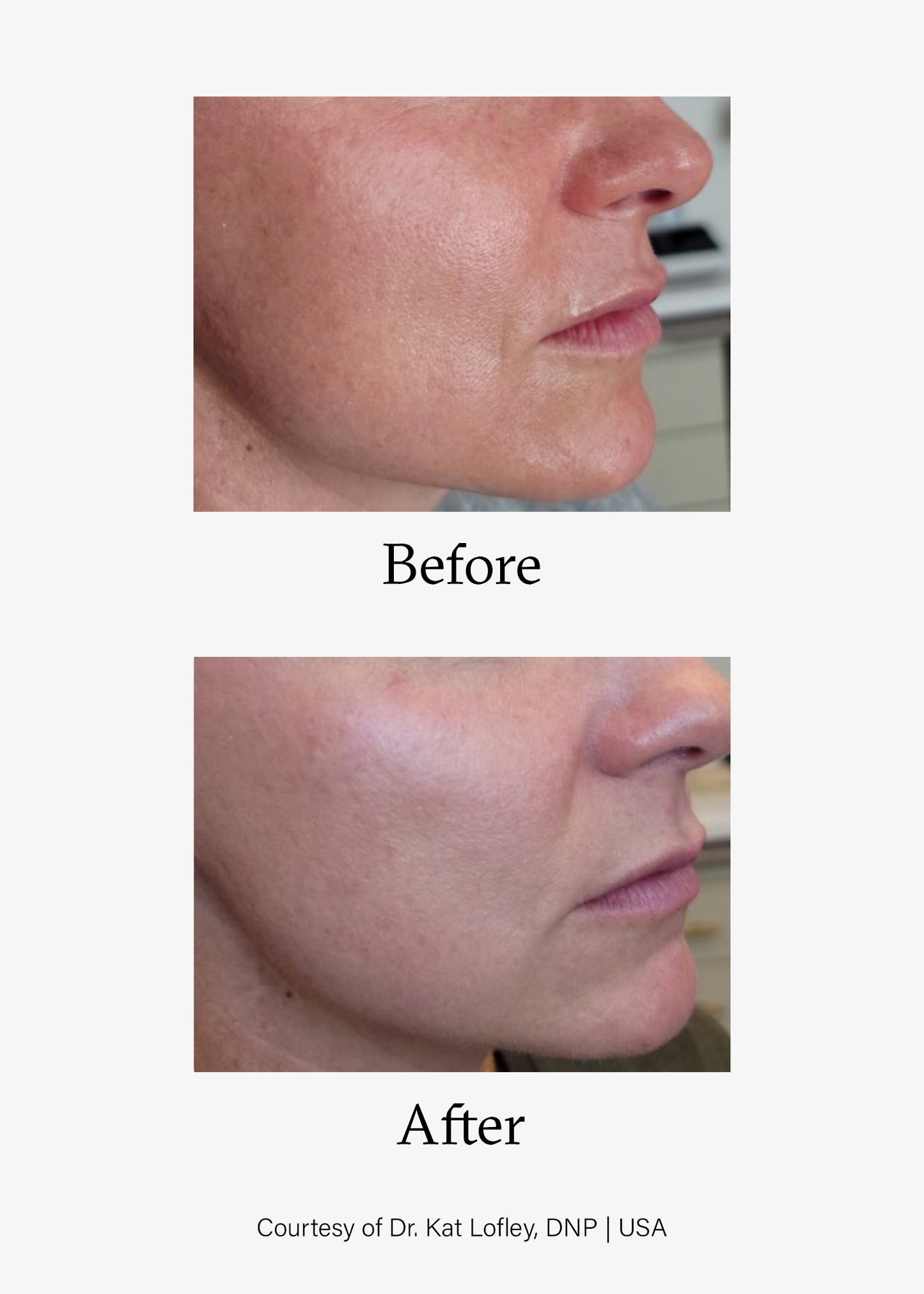 Before and after image of Advanced Skin Resurfacing treatment. Opus Plasma® Powered by Alma® Targeted treatments at Teresa Tarmey skin care Clinic