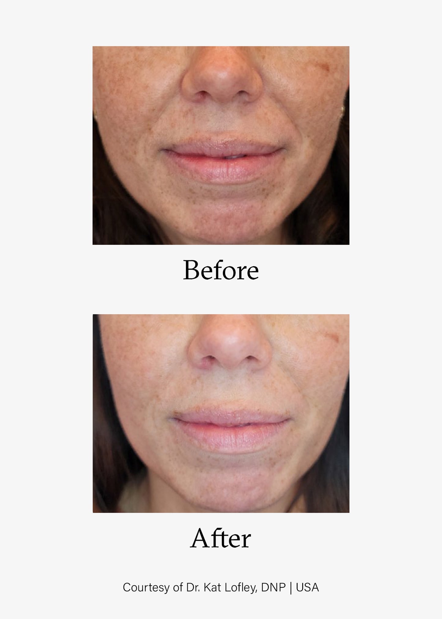 Before and after image of Advanced Skin Resurfacing treatment. Opus Plasma® Powered by Alma® Targeted treatments at Teresa Tarmey skin care Clinic
