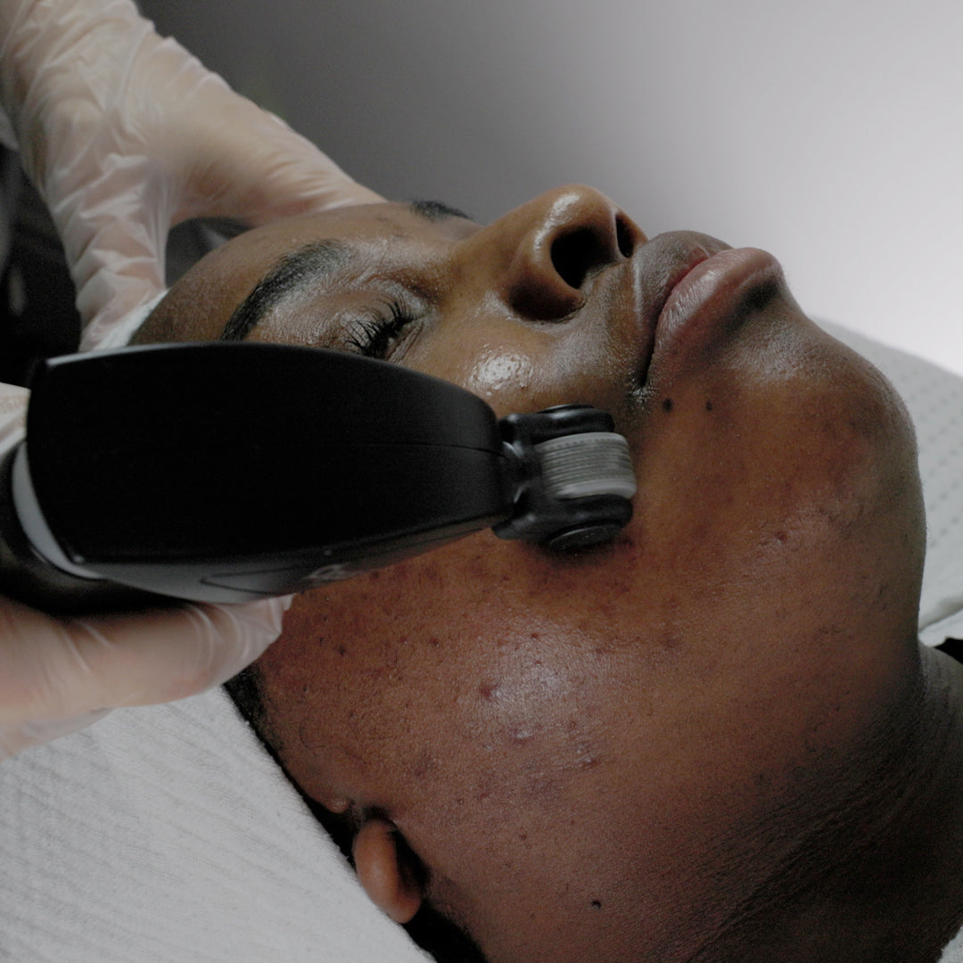 Advanced Skin Resurfacing