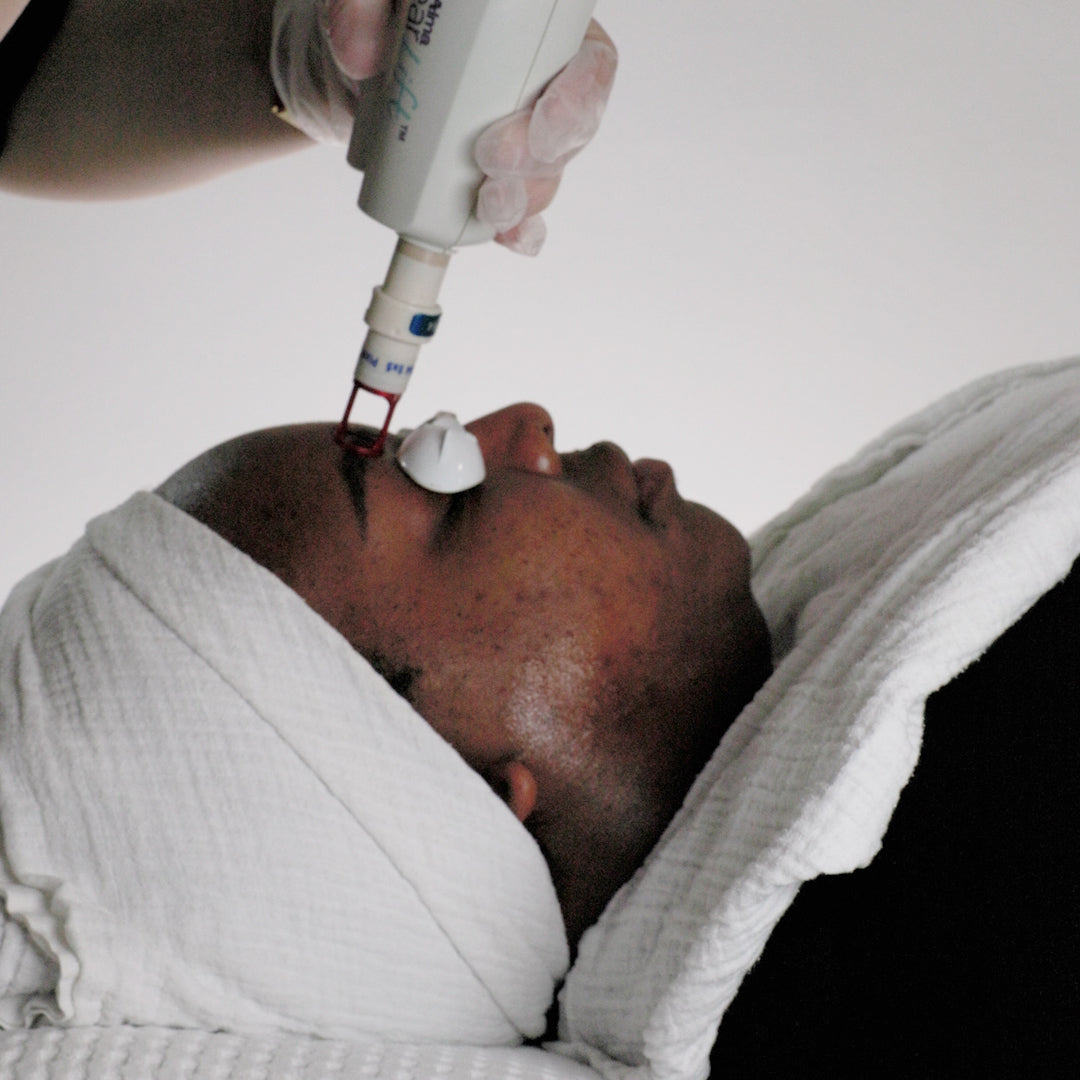 Eyebrow Tattoo Removal