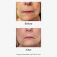 Advanced Skin Resurfacing