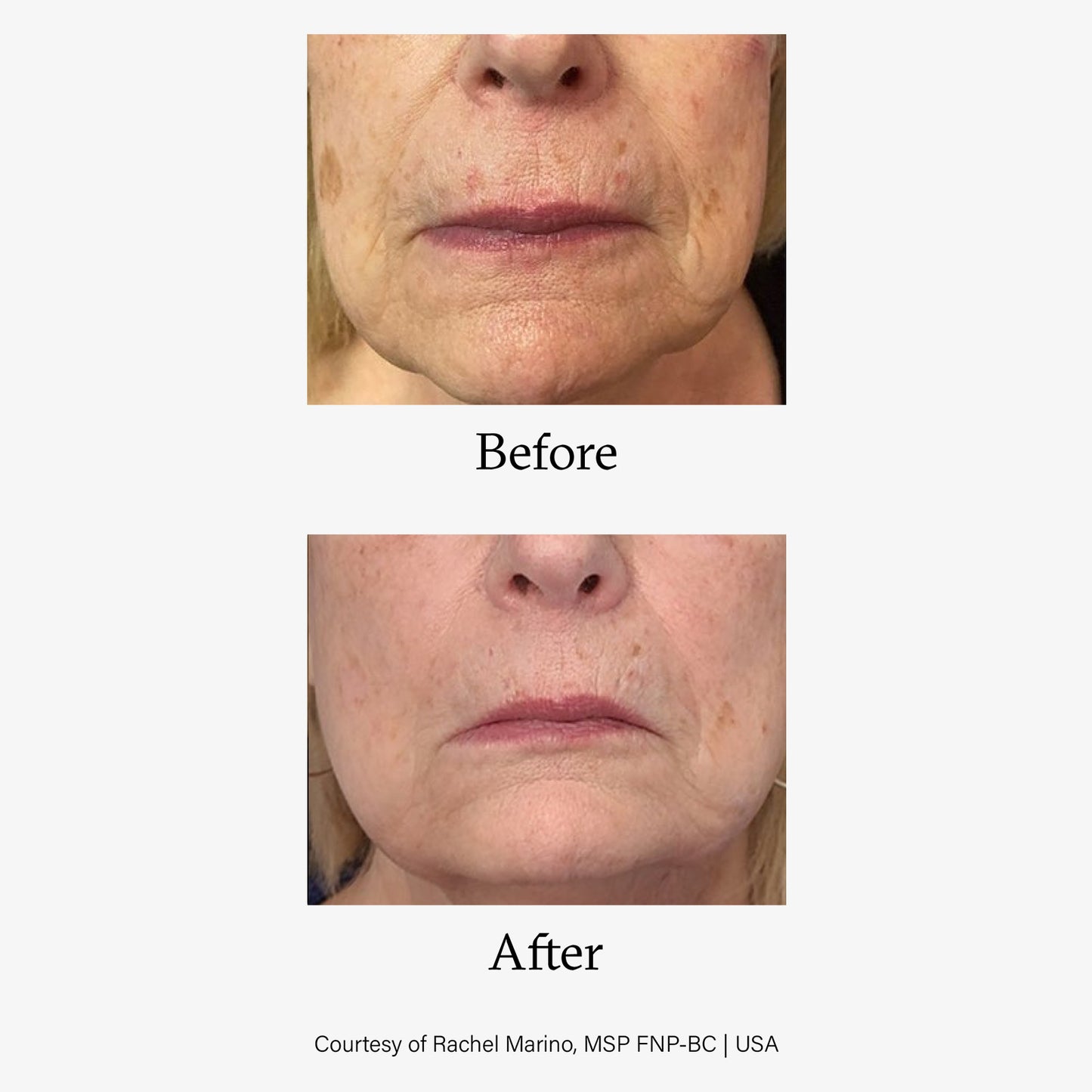 Advanced Skin Resurfacing