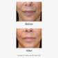 Advanced Skin Resurfacing