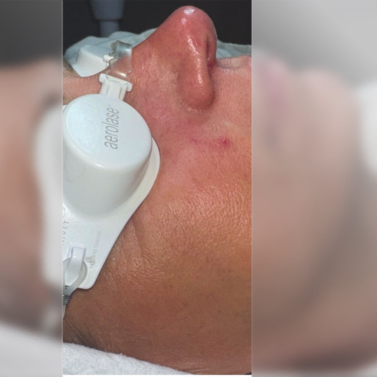 Aerolase Rosacea Treatment