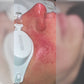 Aerolase Rosacea Treatment