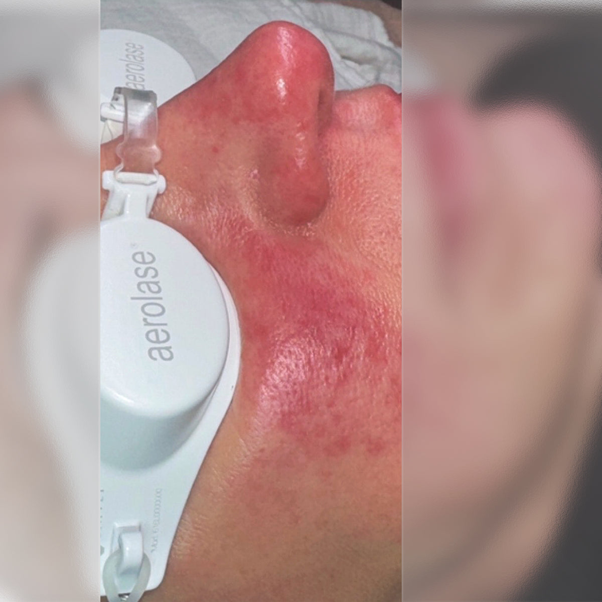 Aerolase Rosacea Treatment