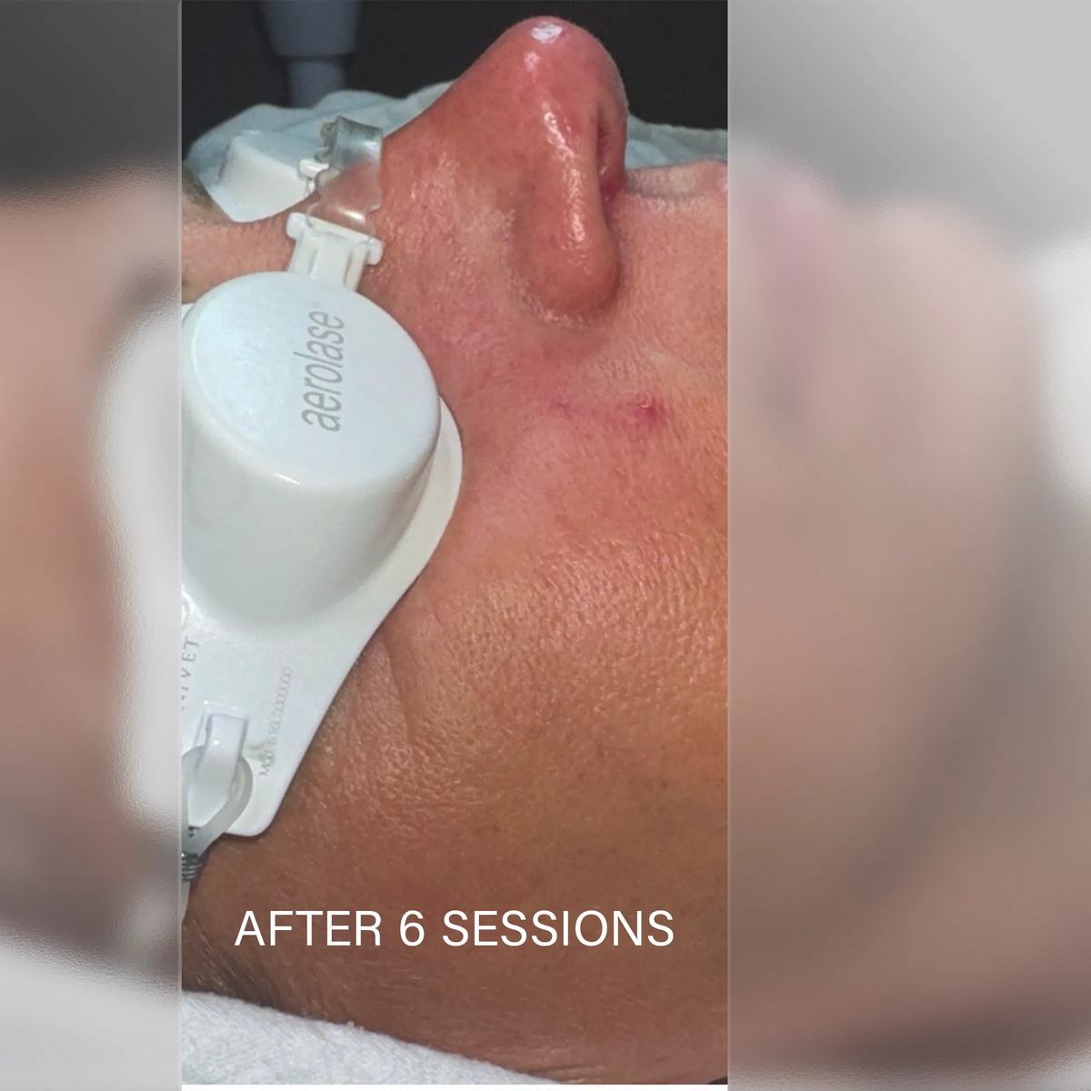 Aerolase Rosacea Treatment