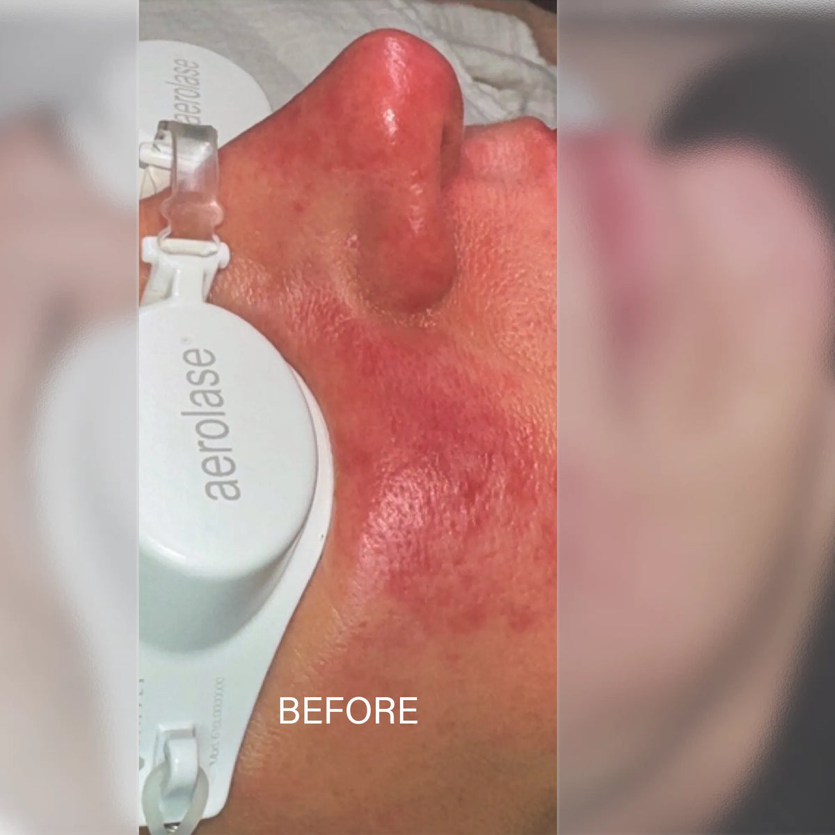 Aerolase Rosacea Treatment