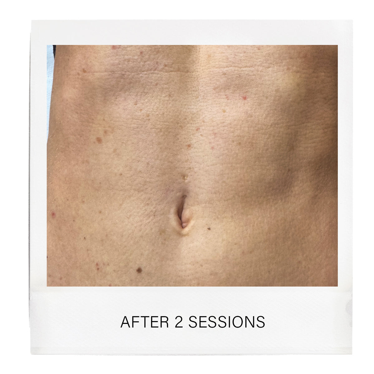 Microneedling Radio Frequency Body