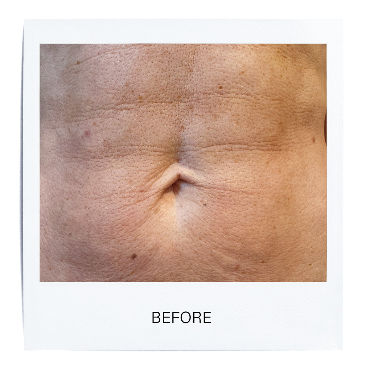 Microneedling Radio Frequency Body