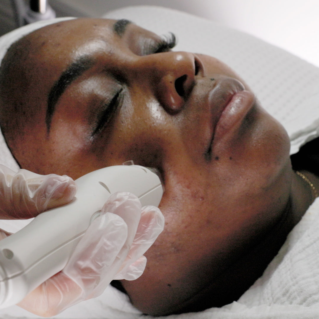 Microneedling Radio Frequency Face and Neck