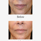 Before and after image of Advanced Skin Resurfacing treatment. Opus Plasma® Powered by Alma® Targeted treatments at Teresa Tarmey skin care Clinic