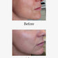 Before and after image of Advanced Skin Resurfacing treatment. Opus Plasma® Powered by Alma® Targeted treatments at Teresa Tarmey skin care Clinic